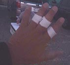手の傷